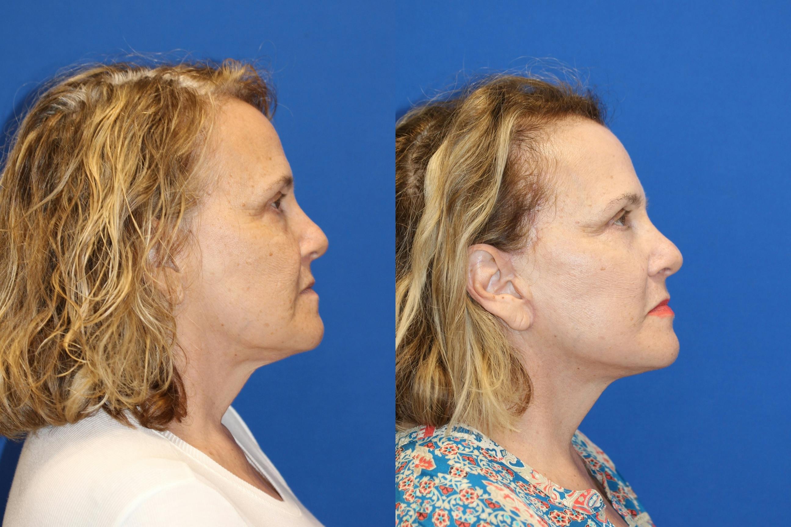 Vertical Restore® / Facial Rejuvenation Gallery - Patient 79839094 - Image 3