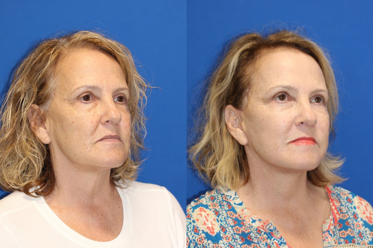 Fat Transfer Before & After Gallery - Patient 91507285 - Image 2