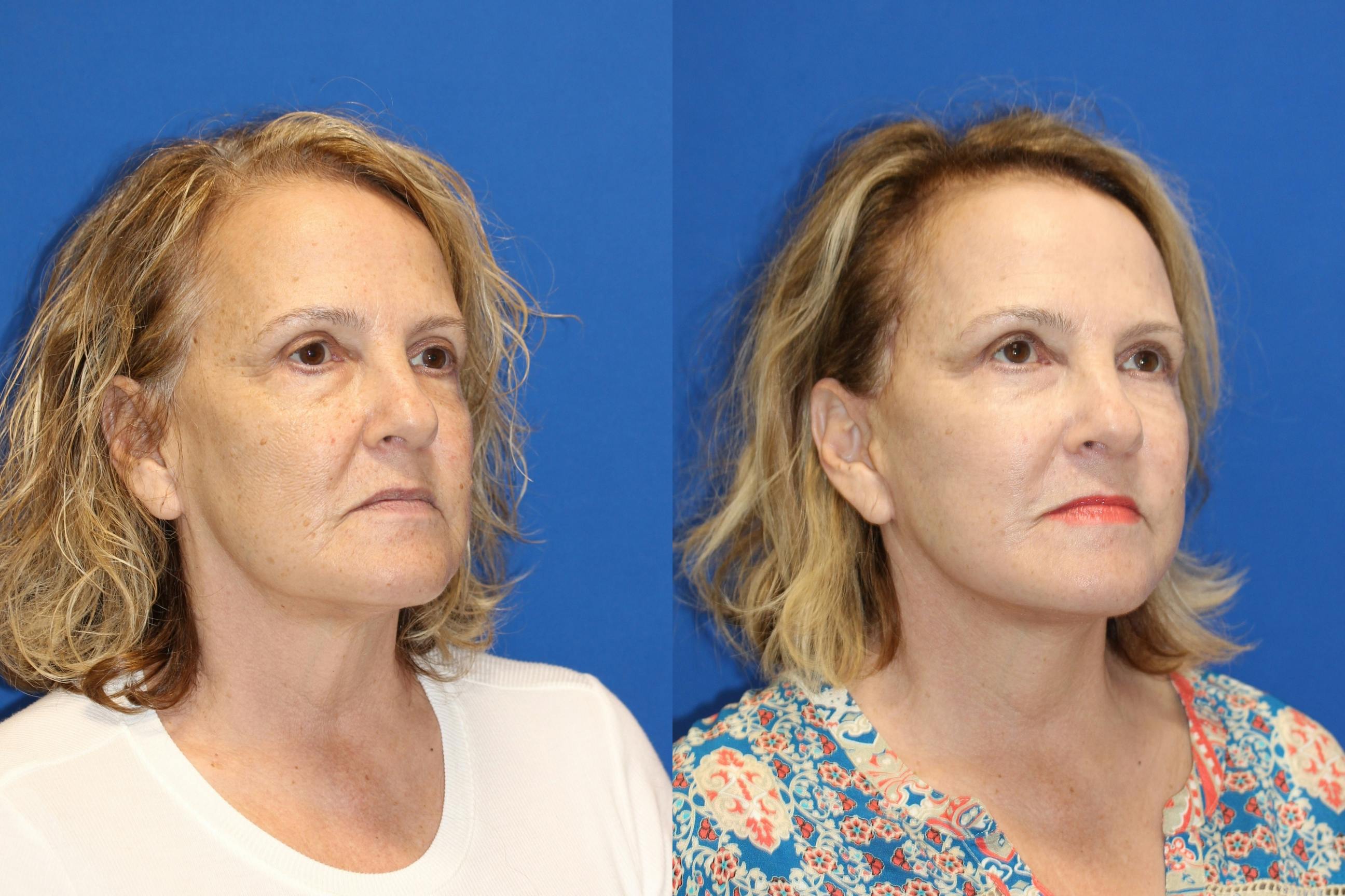 Vertical Restore® / Facial Rejuvenation Gallery - Patient 79839094 - Image 2