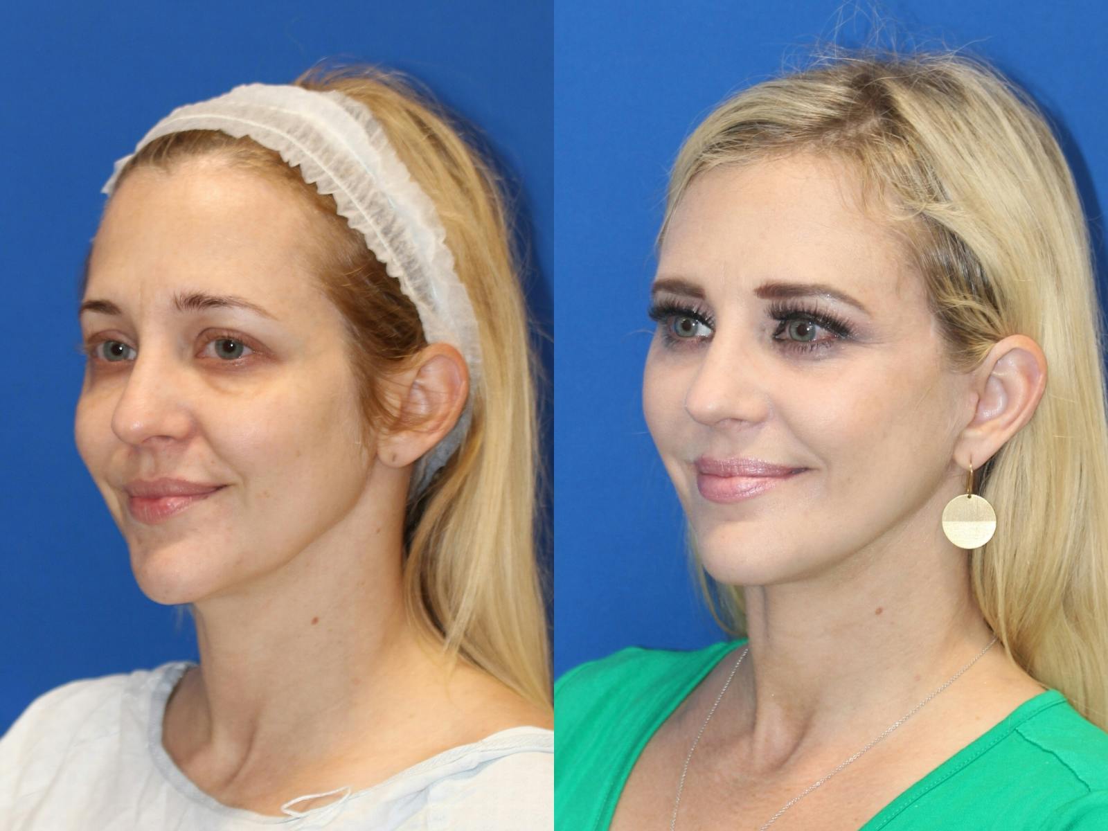 Fat Transfer Before & After Gallery - Patient 89266095 - Image 3
