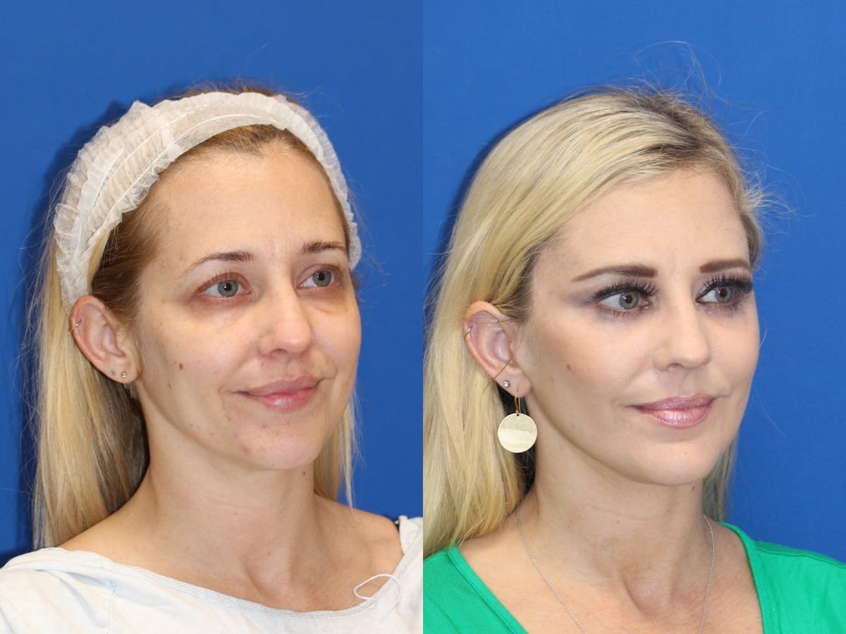 Fat Transfer Before & After Gallery - Patient 89266095 - Image 2