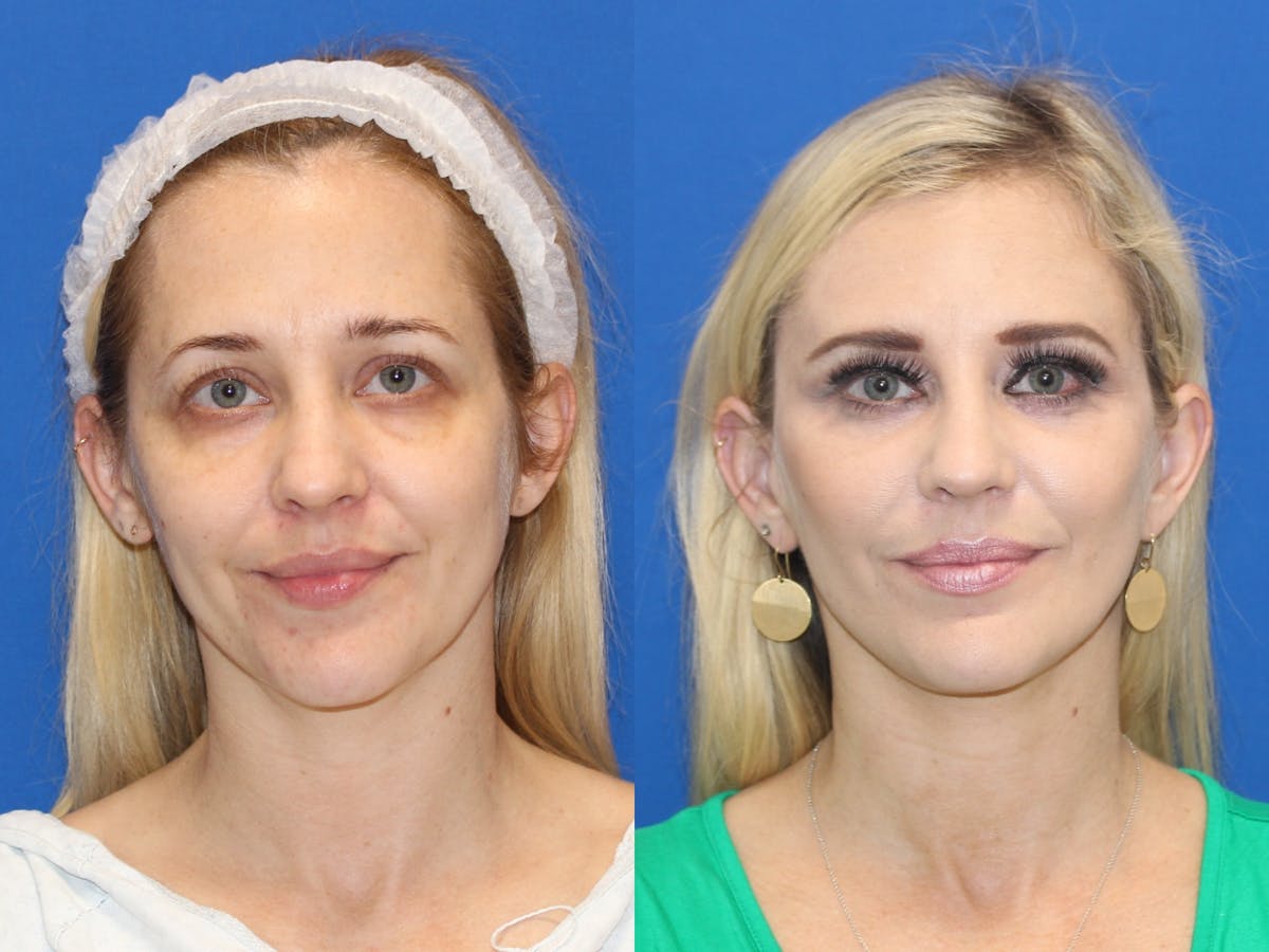 Vertical Restore® / Facial Rejuvenation Before & After Gallery - Patient 83099678 - Image 1