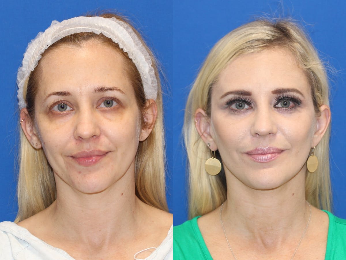 Fat Transfer Before & After Gallery - Patient 89266095 - Image 1