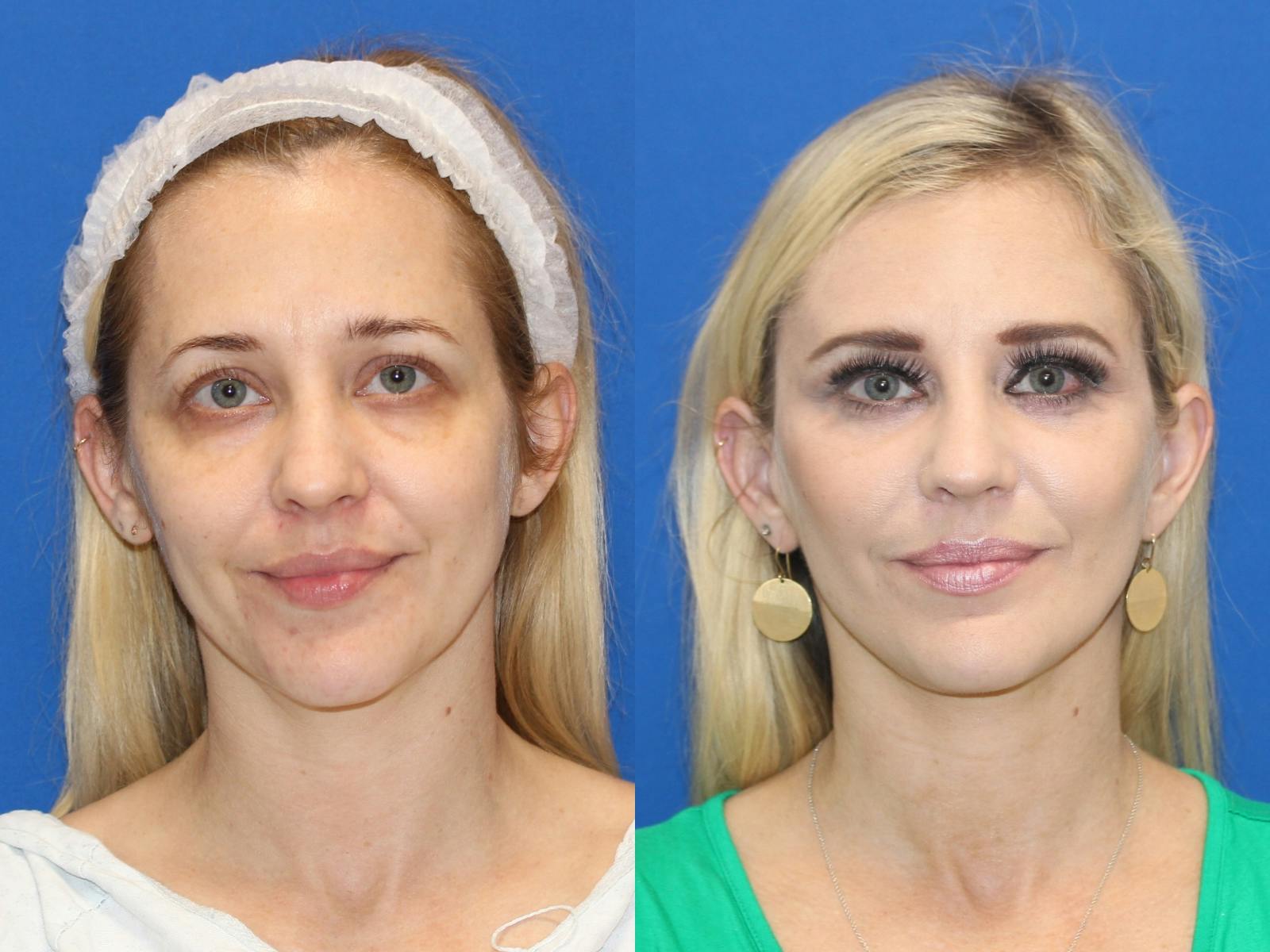 Vertical Restore® / Facial Rejuvenation Before & After Gallery - Patient 83099678 - Image 1
