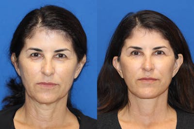 Vertical Restore® / Facial Rejuvenation Before & After Gallery - Patient 102564156 - Image 1