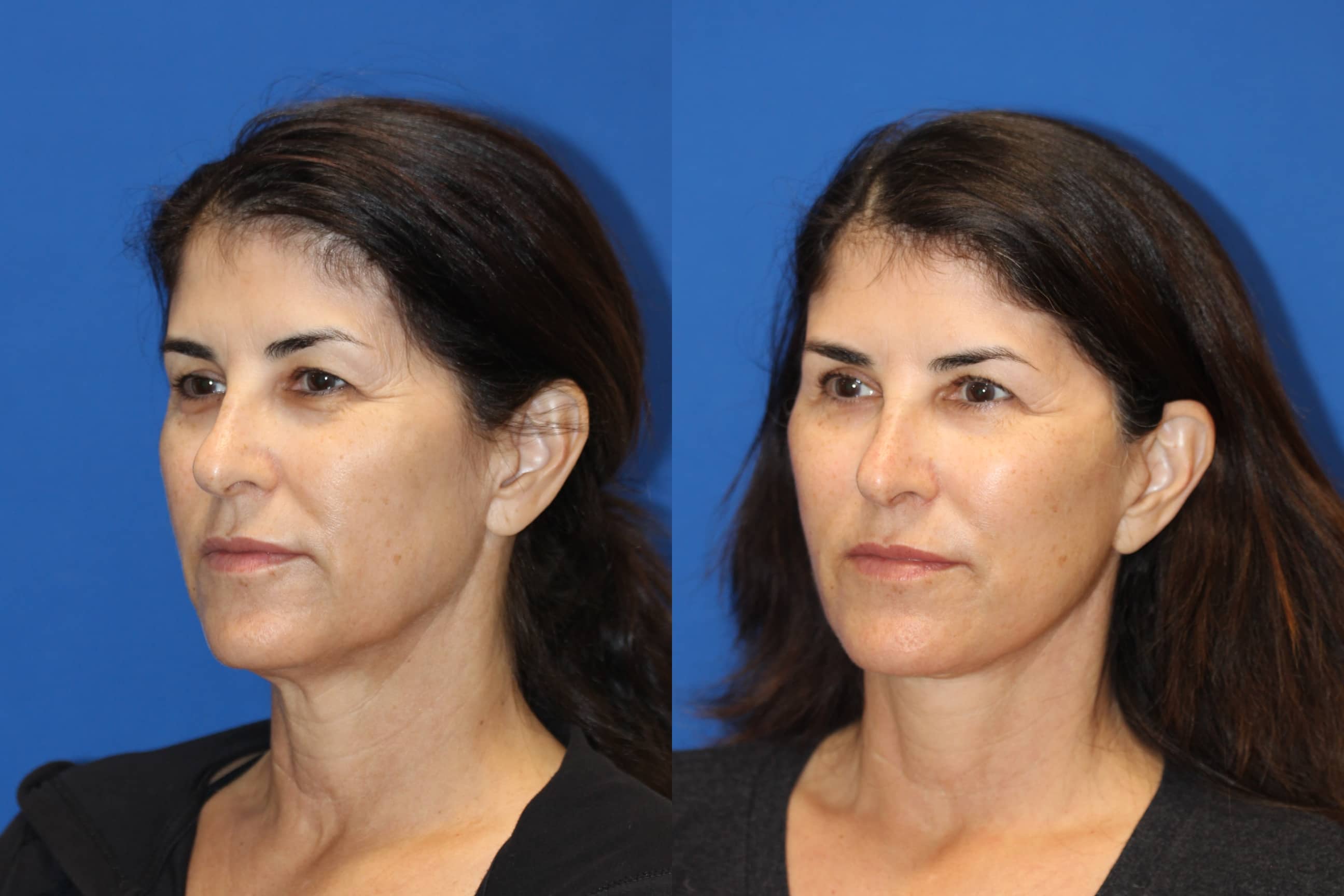 Patient 102564156 Vertical Restore® / Facial Rejuvenation Before & After Photos Carmel