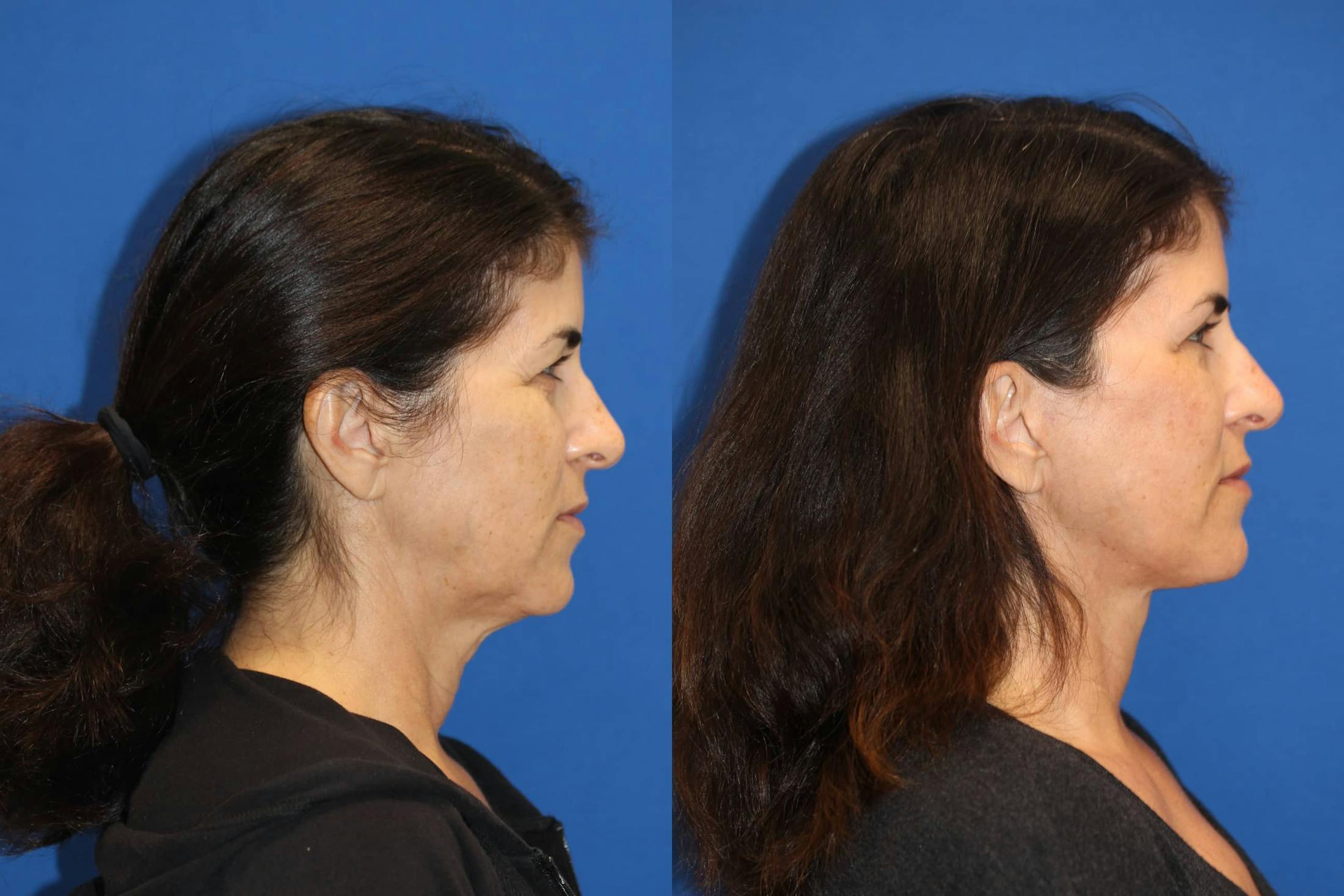Vertical Restore® / Facial Rejuvenation Before & After Gallery - Patient 102564156 - Image 3