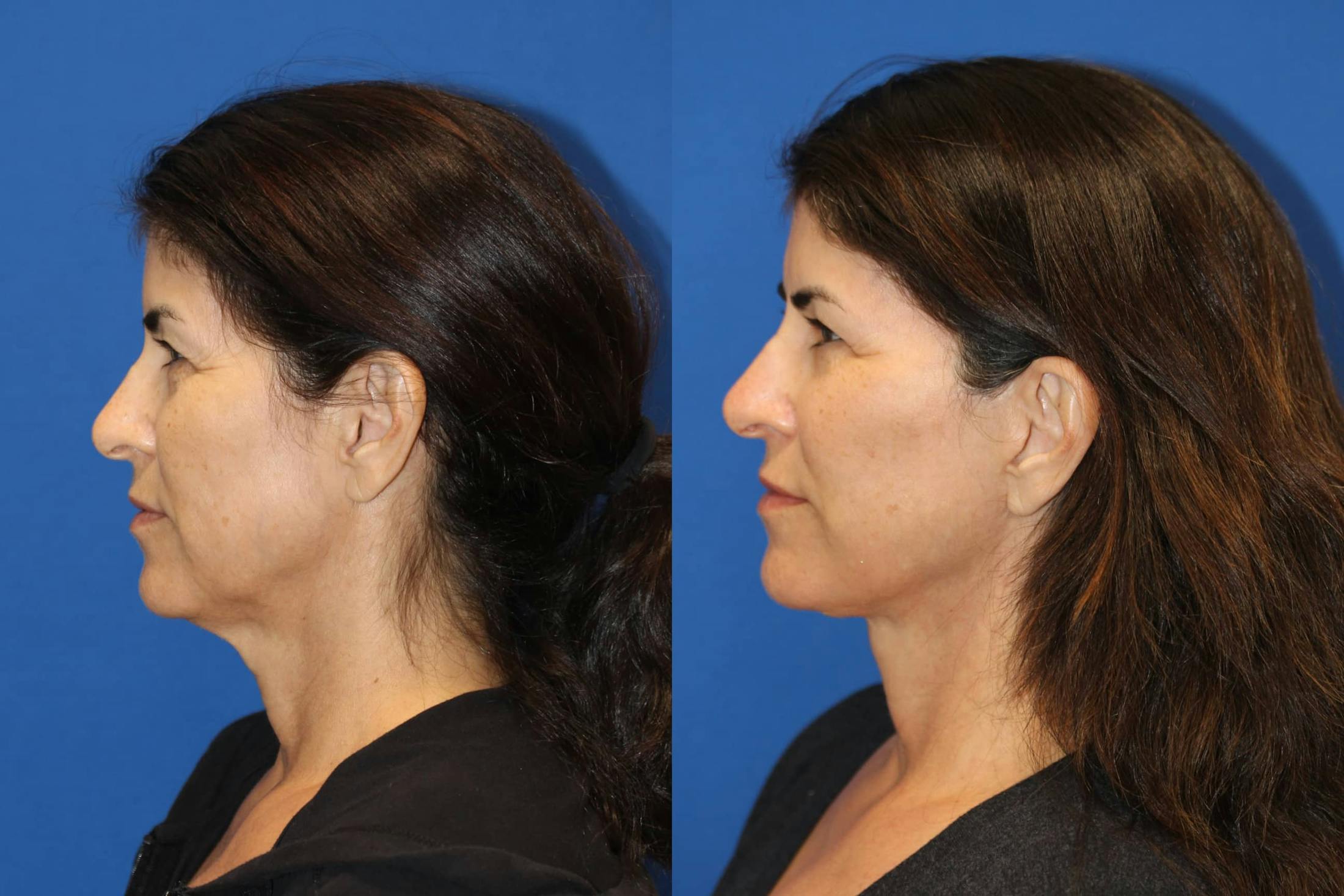 Vertical Restore® / Facial Rejuvenation Before & After Gallery - Patient 102564156 - Image 4