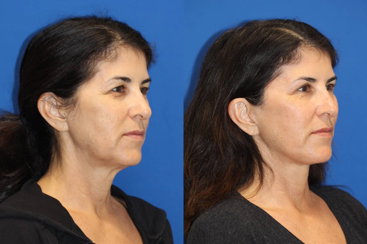 Vertical Restore® / Facial Rejuvenation Before & After Gallery - Patient 102564156 - Image 5