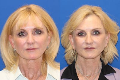 Vertical Restore® / Facial Rejuvenation Before & After Gallery - Patient 123045405 - Image 1