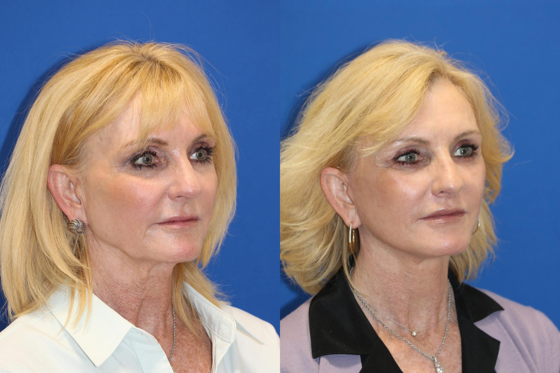 Vertical Restore® / Facial Rejuvenation Before & After Gallery - Patient 123045405 - Image 2