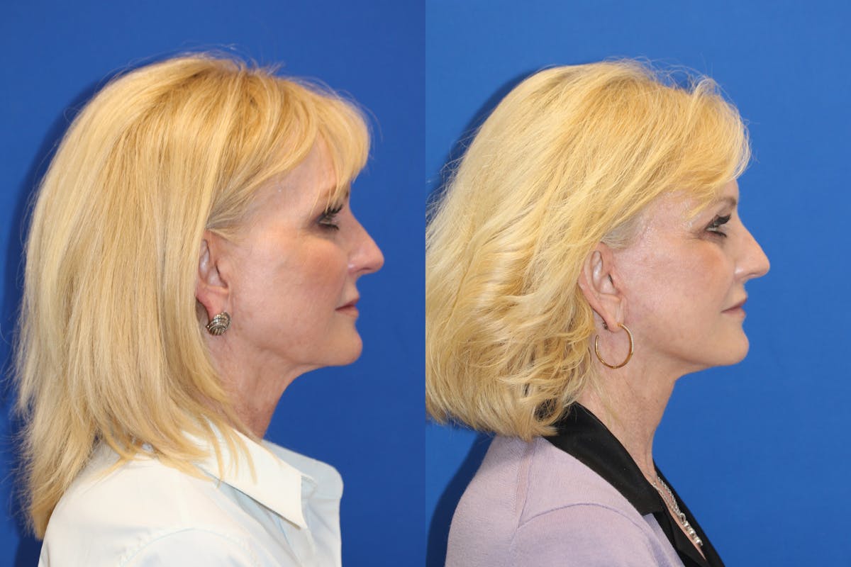 Vertical Restore® / Facial Rejuvenation Before & After Gallery - Patient 123045405 - Image 4