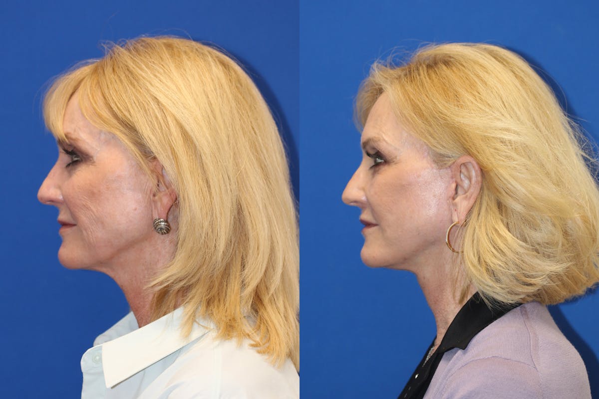 Vertical Restore® / Facial Rejuvenation Before & After Gallery - Patient 123045405 - Image 5