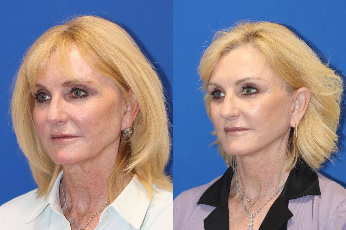 Vertical Restore® / Facial Rejuvenation Before & After Gallery - Patient 123045405 - Image 3
