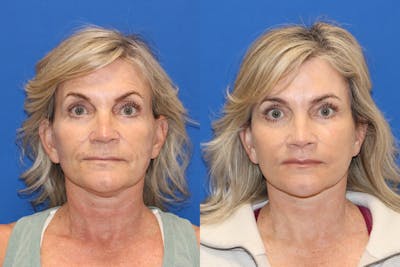 Vertical Restore® / Facial Rejuvenation Before & After Gallery - Patient 123065365 - Image 1