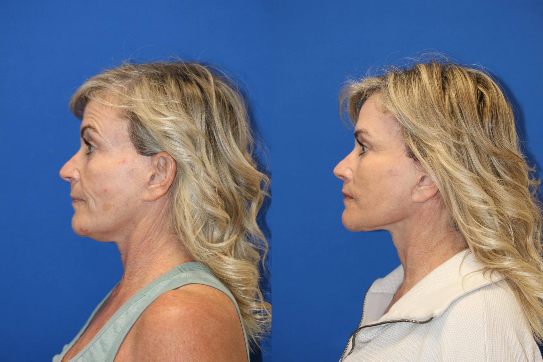 Vertical Restore® / Facial Rejuvenation Before & After Gallery - Patient 123065365 - Image 2