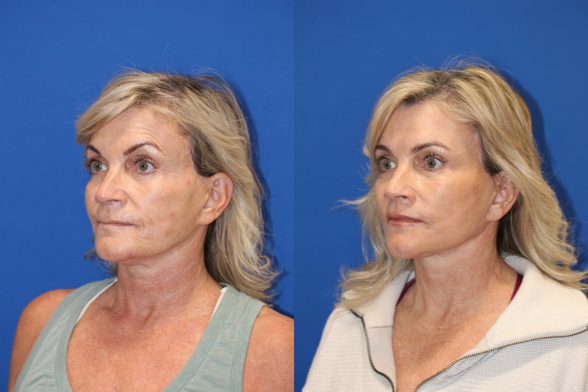 Vertical Restore® / Facial Rejuvenation Before & After Gallery - Patient 123065365 - Image 3