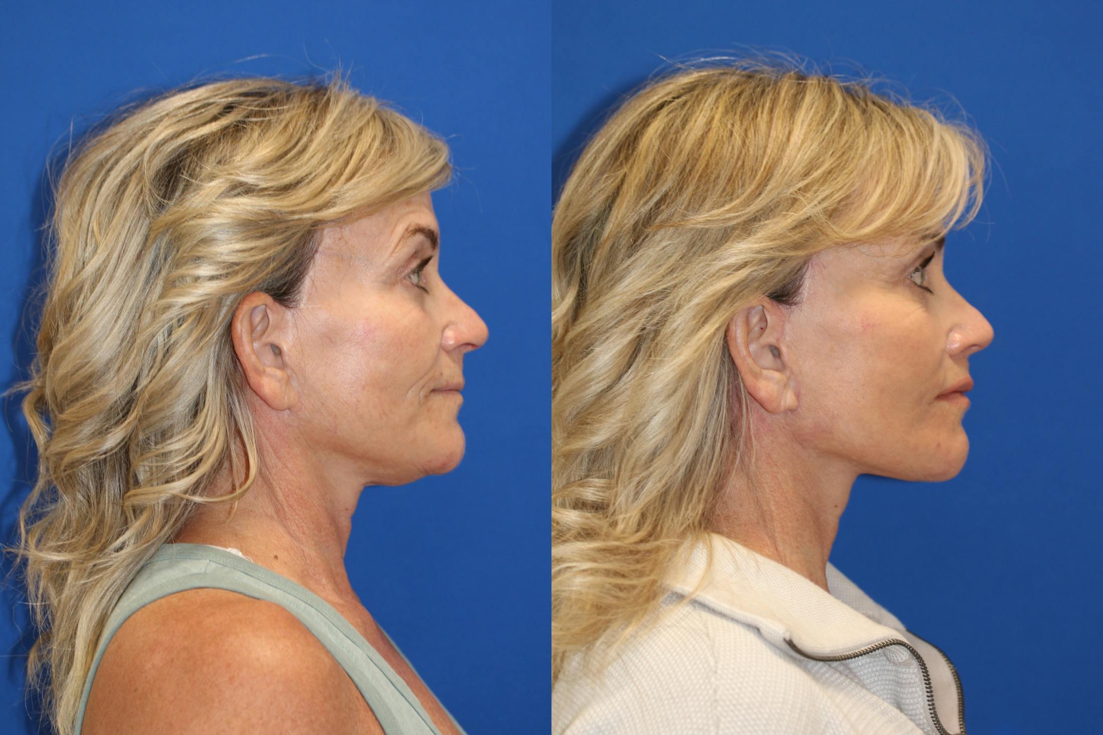 Vertical Restore® / Facial Rejuvenation Before & After Gallery - Patient 123065365 - Image 4