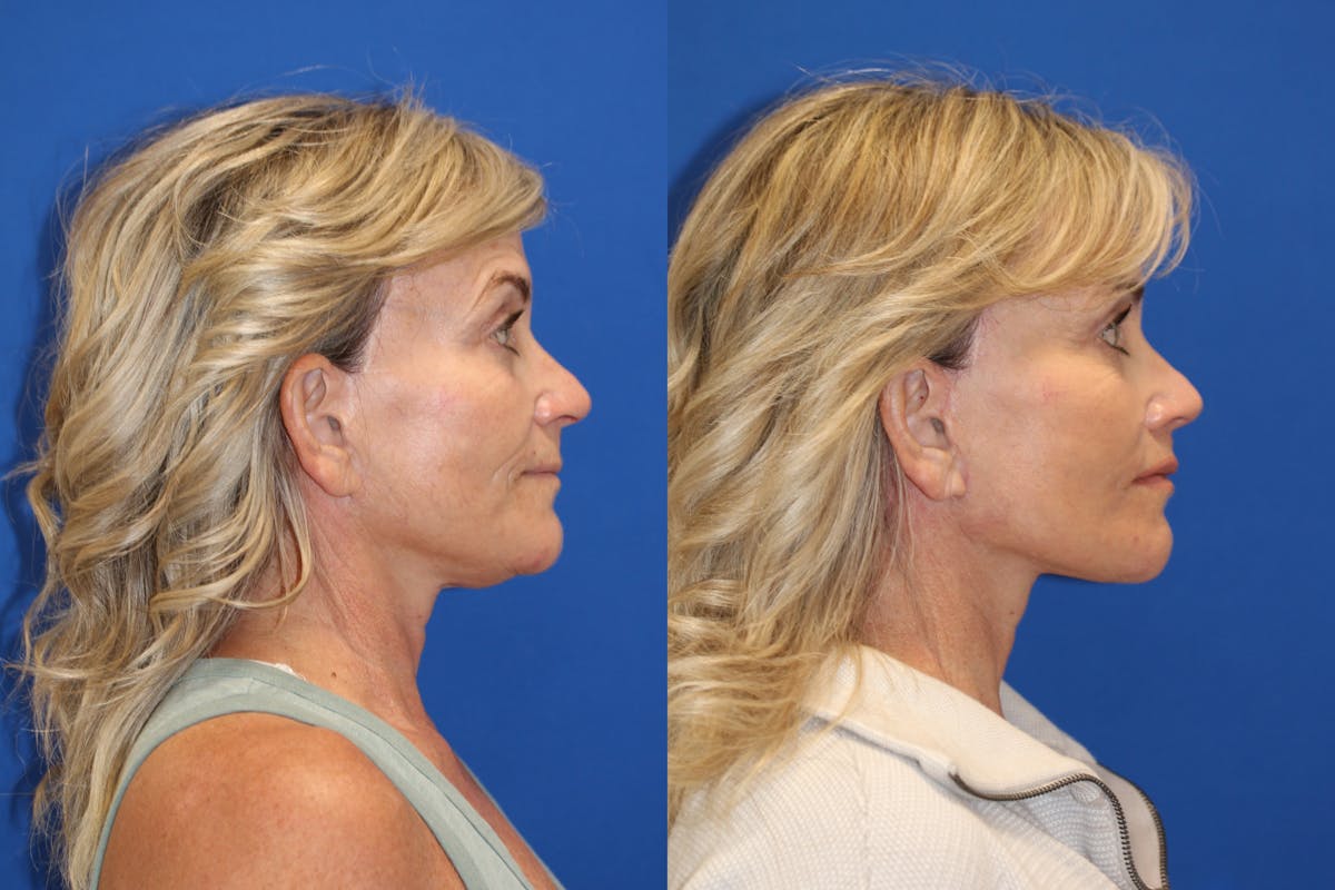 Vertical Restore® / Facial Rejuvenation Before & After Gallery - Patient 123065365 - Image 4