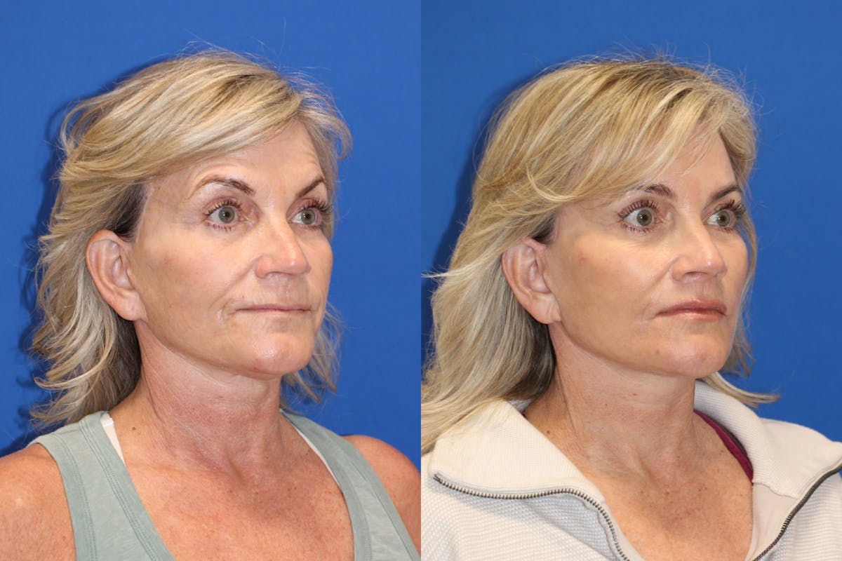 Vertical Restore® / Facial Rejuvenation Before & After Gallery - Patient 123065365 - Image 5