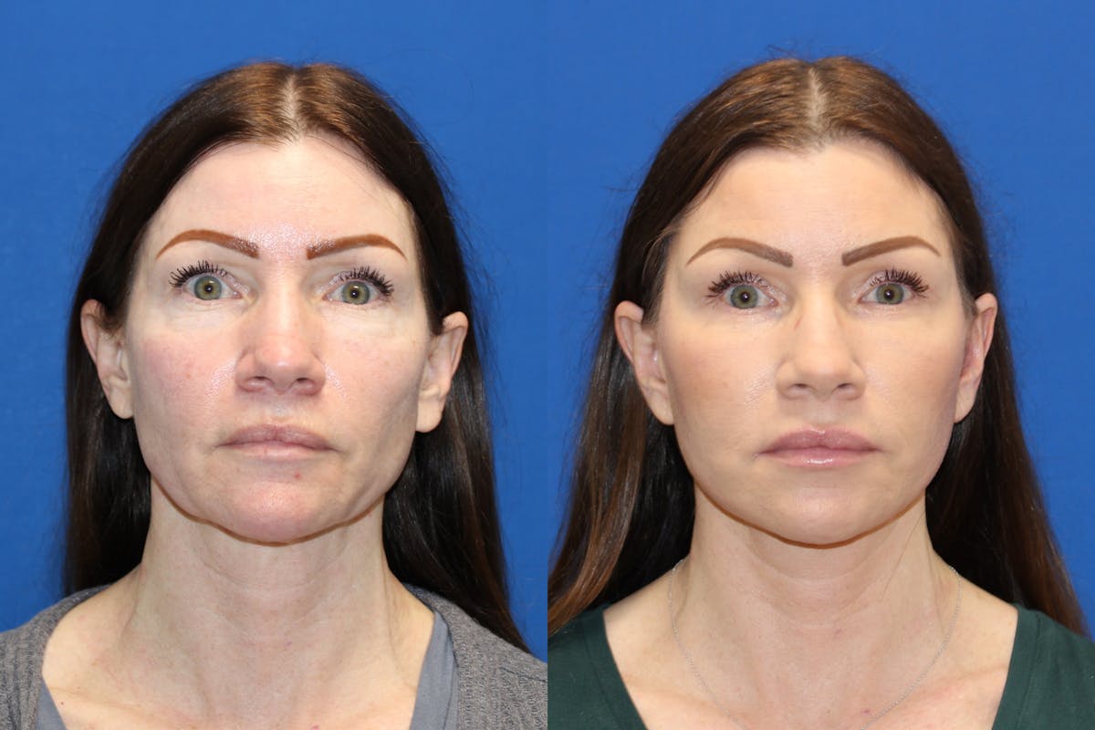Vertical Restore® / Facial Rejuvenation Before & After Gallery - Patient 123065437 - Image 1