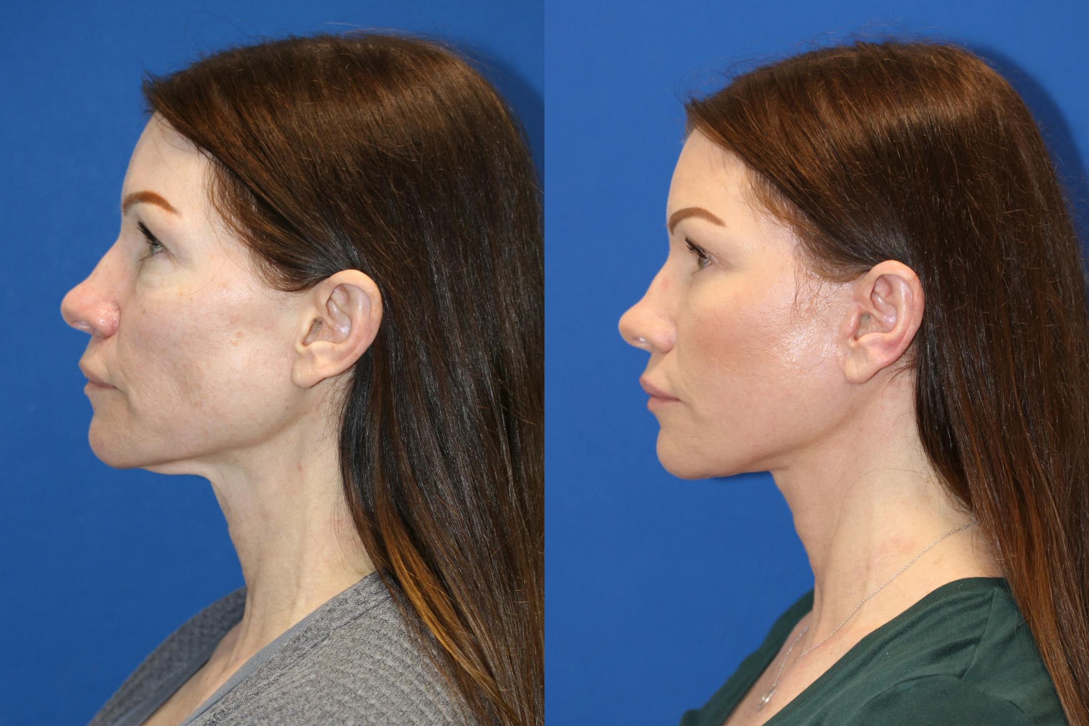 Vertical Restore® / Facial Rejuvenation Before & After Gallery - Patient 123065437 - Image 2