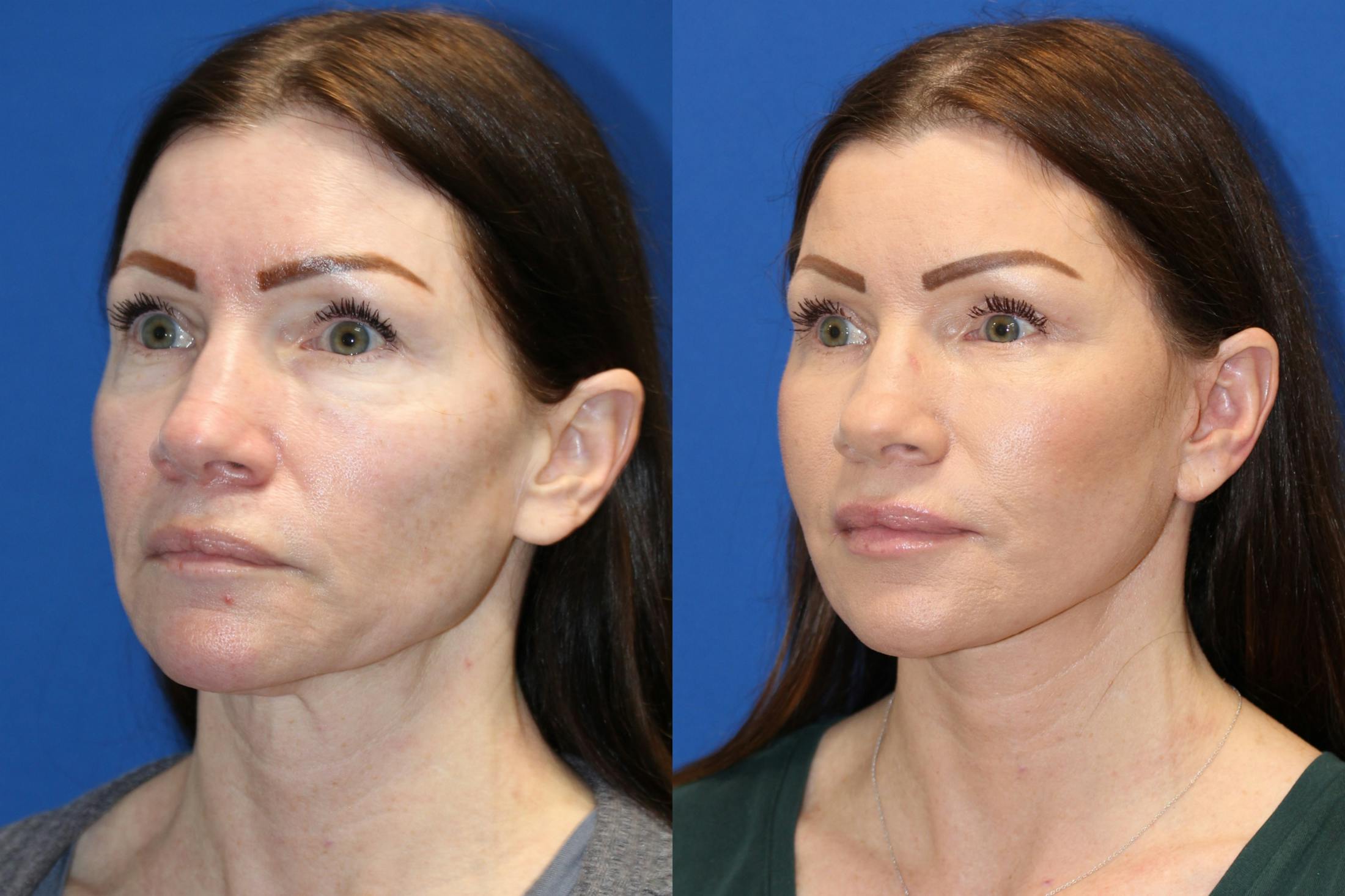 Vertical Restore® / Facial Rejuvenation Before & After Gallery - Patient 123065437 - Image 3