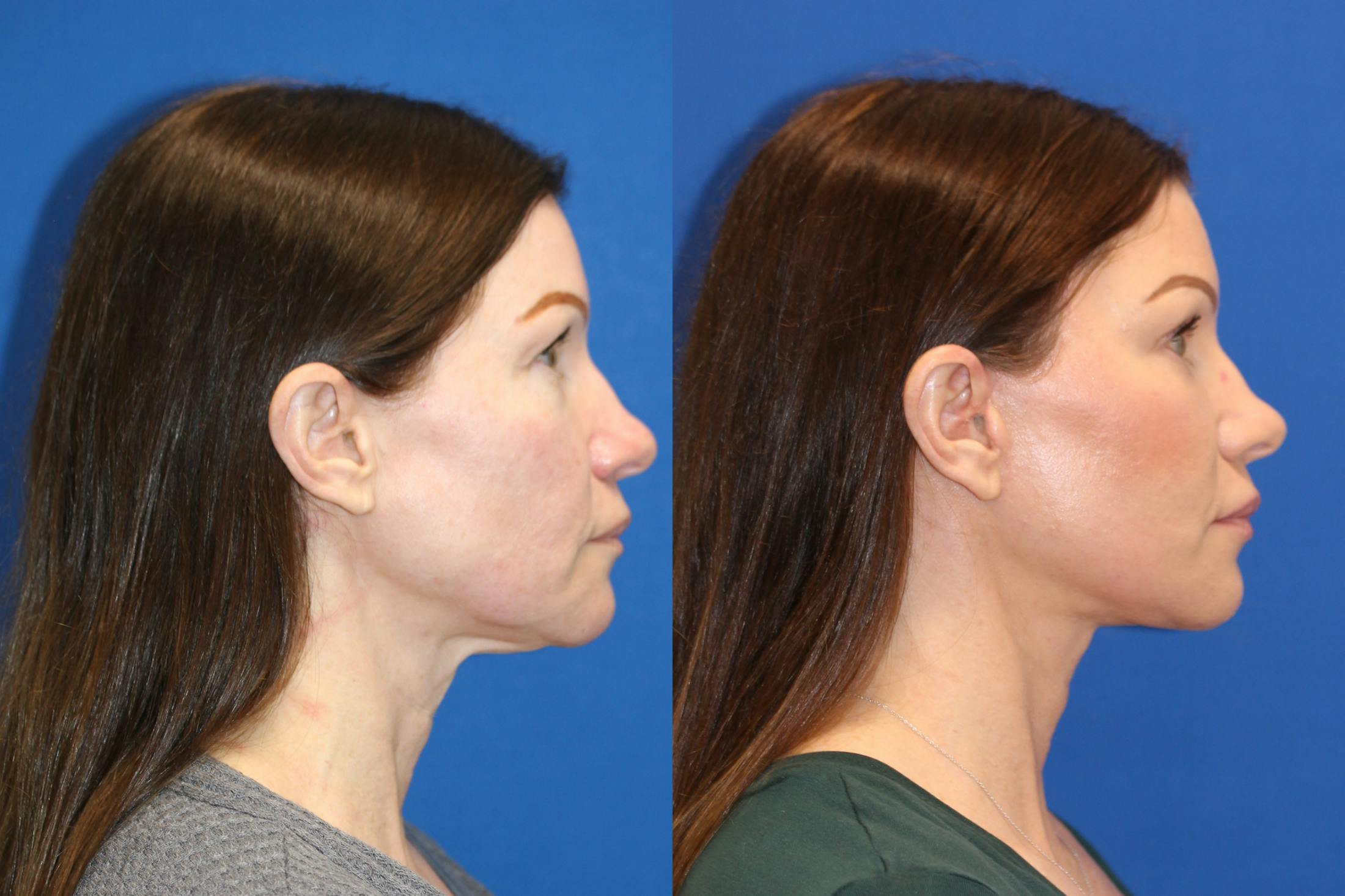 Vertical Restore® / Facial Rejuvenation Before & After Gallery - Patient 123065437 - Image 4