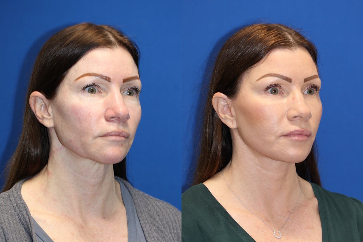 Vertical Restore® / Facial Rejuvenation Before & After Gallery - Patient 123065437 - Image 5