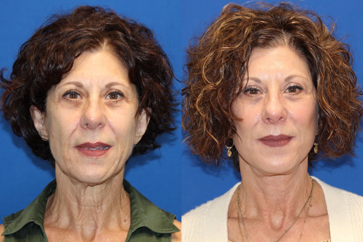 Vertical Restore® / Facial Rejuvenation Before & After Gallery - Patient 123065454 - Image 1