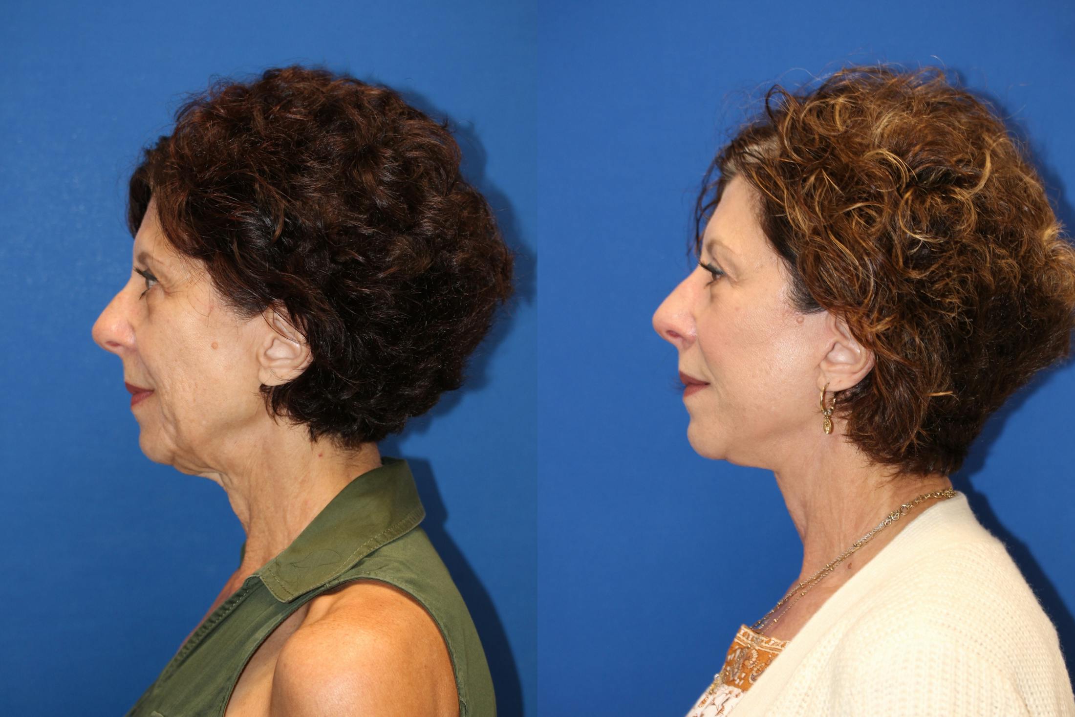 Vertical Restore® / Facial Rejuvenation Before & After Gallery - Patient 123065454 - Image 2