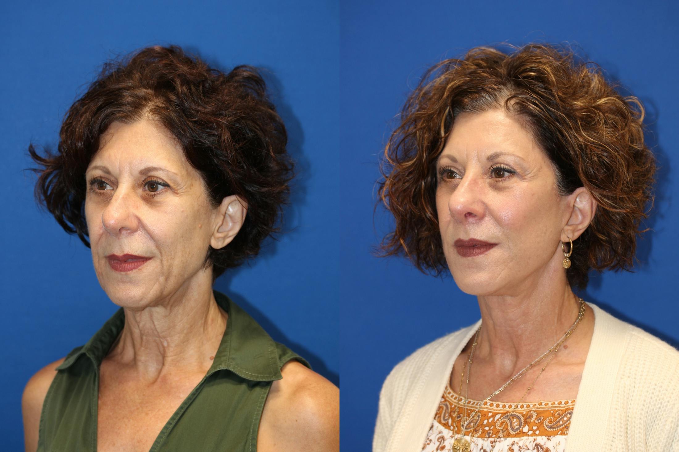 Vertical Restore® / Facial Rejuvenation Before & After Gallery - Patient 123065454 - Image 3