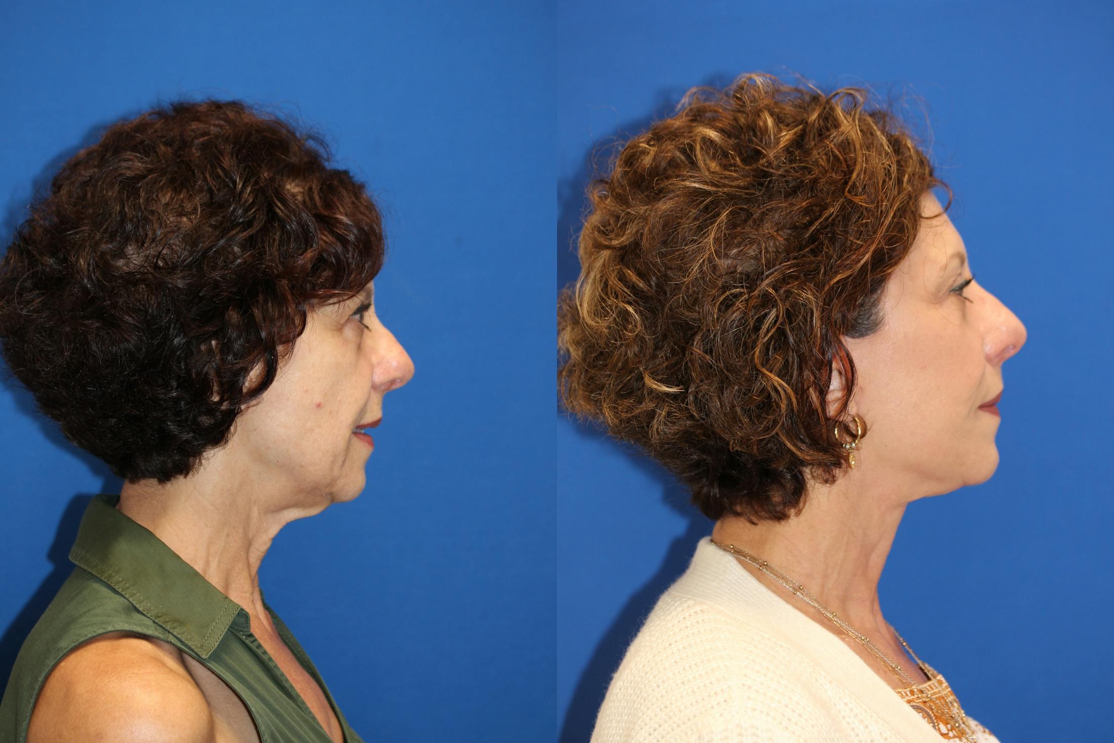 Vertical Restore® / Facial Rejuvenation Before & After Gallery - Patient 123065454 - Image 4