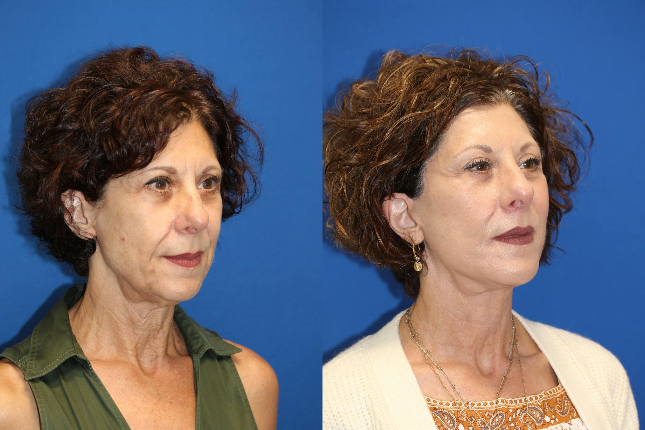 Vertical Restore® / Facial Rejuvenation Before & After Gallery - Patient 123065454 - Image 5