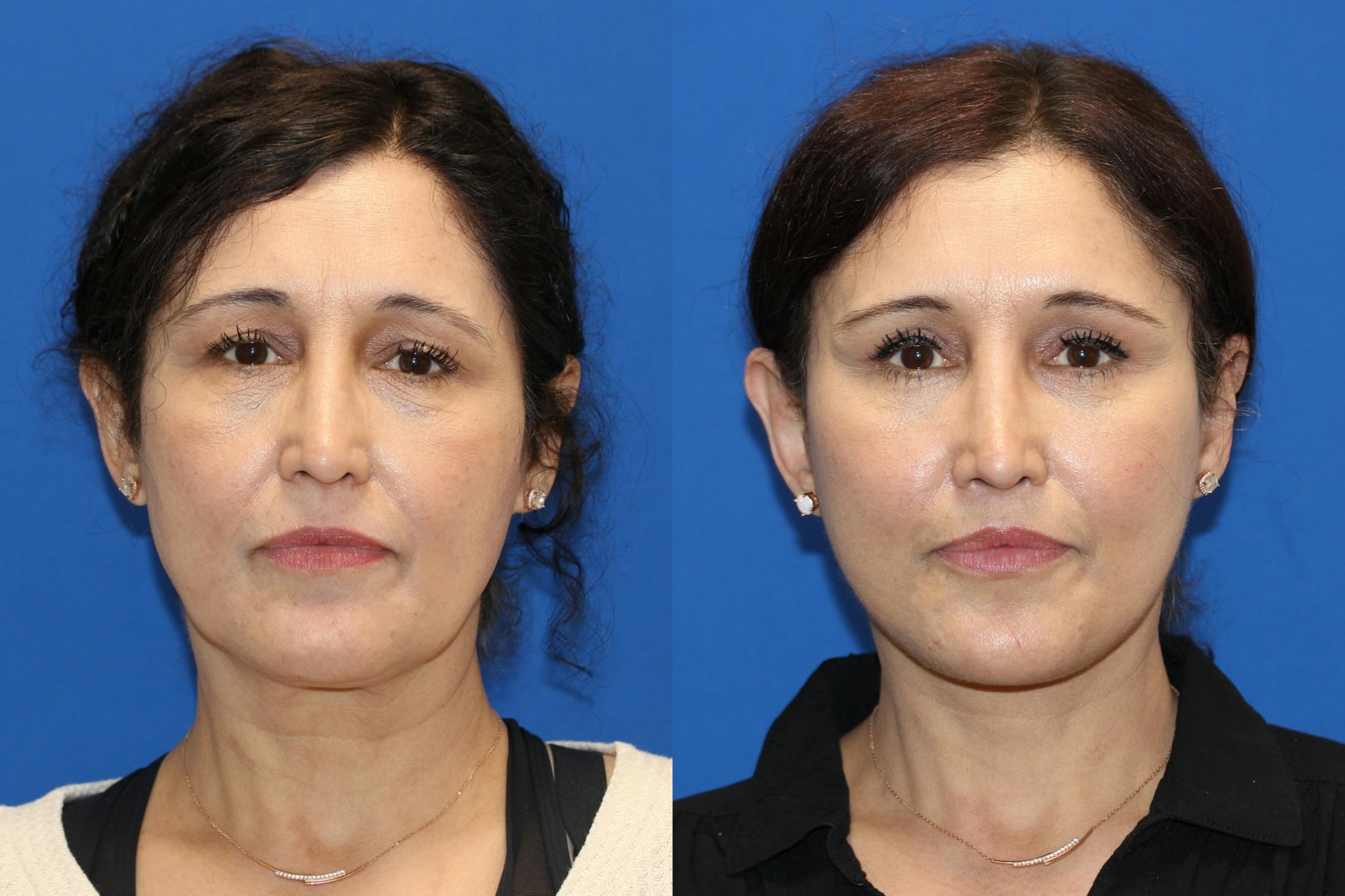 Vertical Restore® / Facial Rejuvenation Before & After Gallery - Patient 123065497 - Image 1