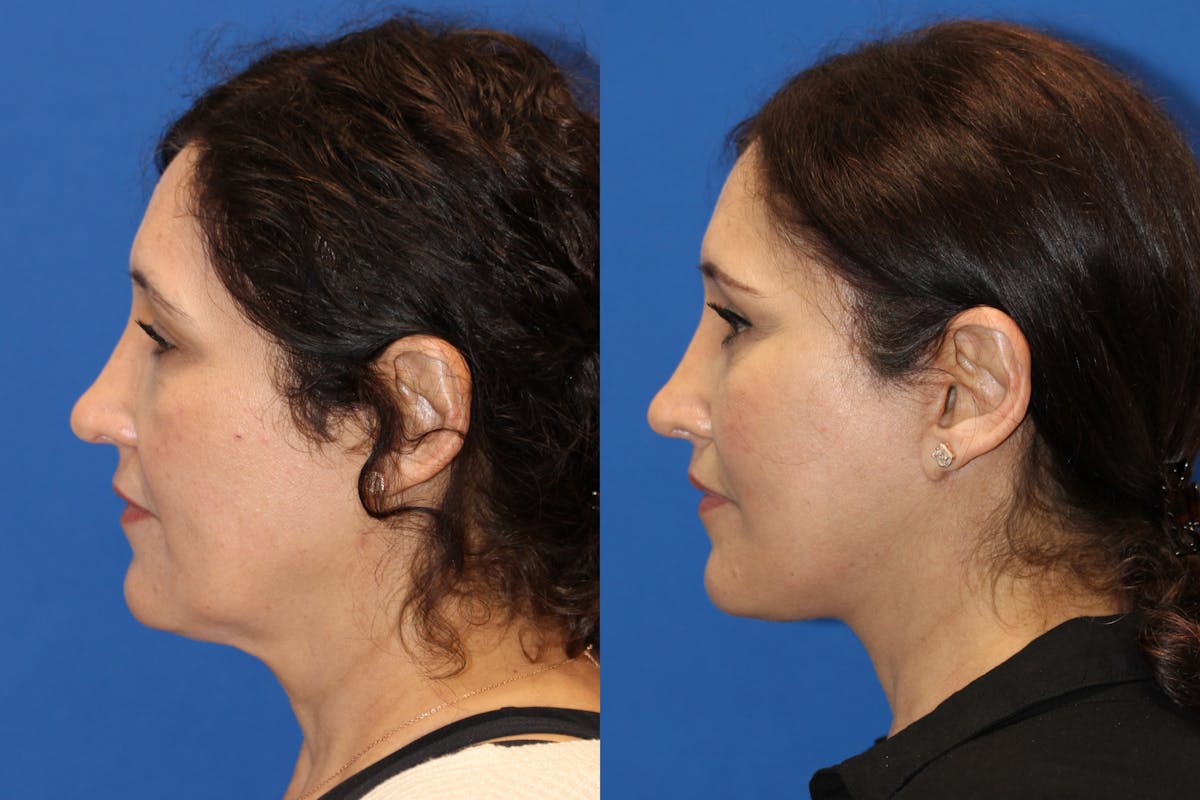 Vertical Restore® / Facial Rejuvenation Before & After Gallery - Patient 123065497 - Image 2