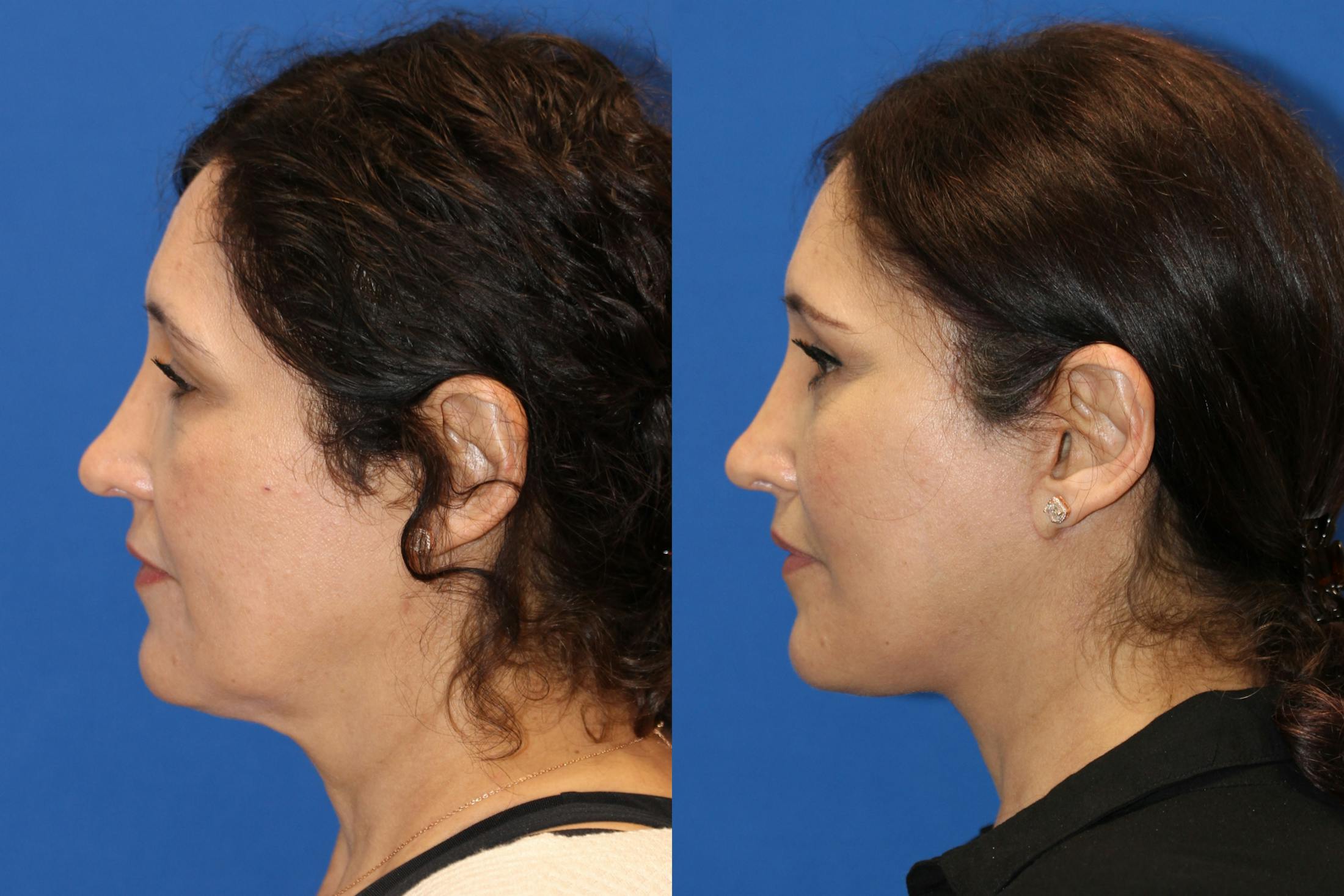Vertical Restore® / Facial Rejuvenation Before & After Gallery - Patient 123065497 - Image 2