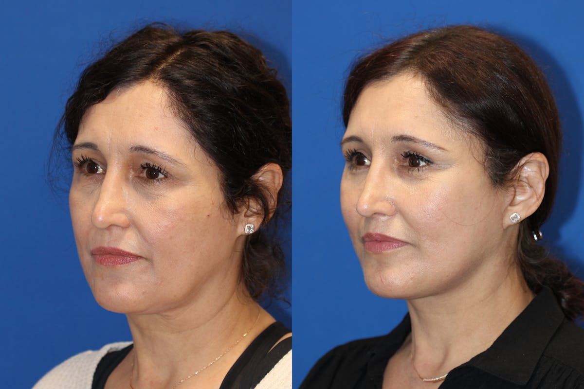Vertical Restore® / Facial Rejuvenation Before & After Gallery - Patient 123065497 - Image 3