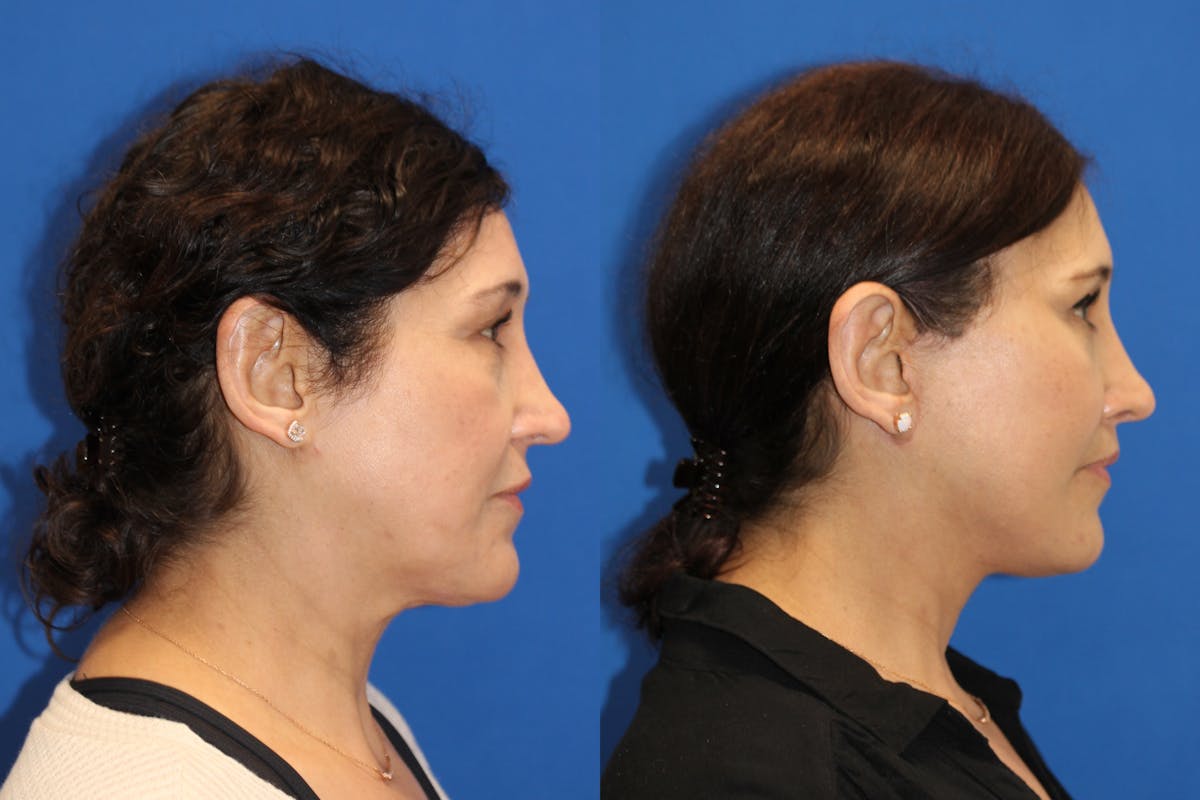 Vertical Restore® / Facial Rejuvenation Before & After Gallery - Patient 123065497 - Image 4