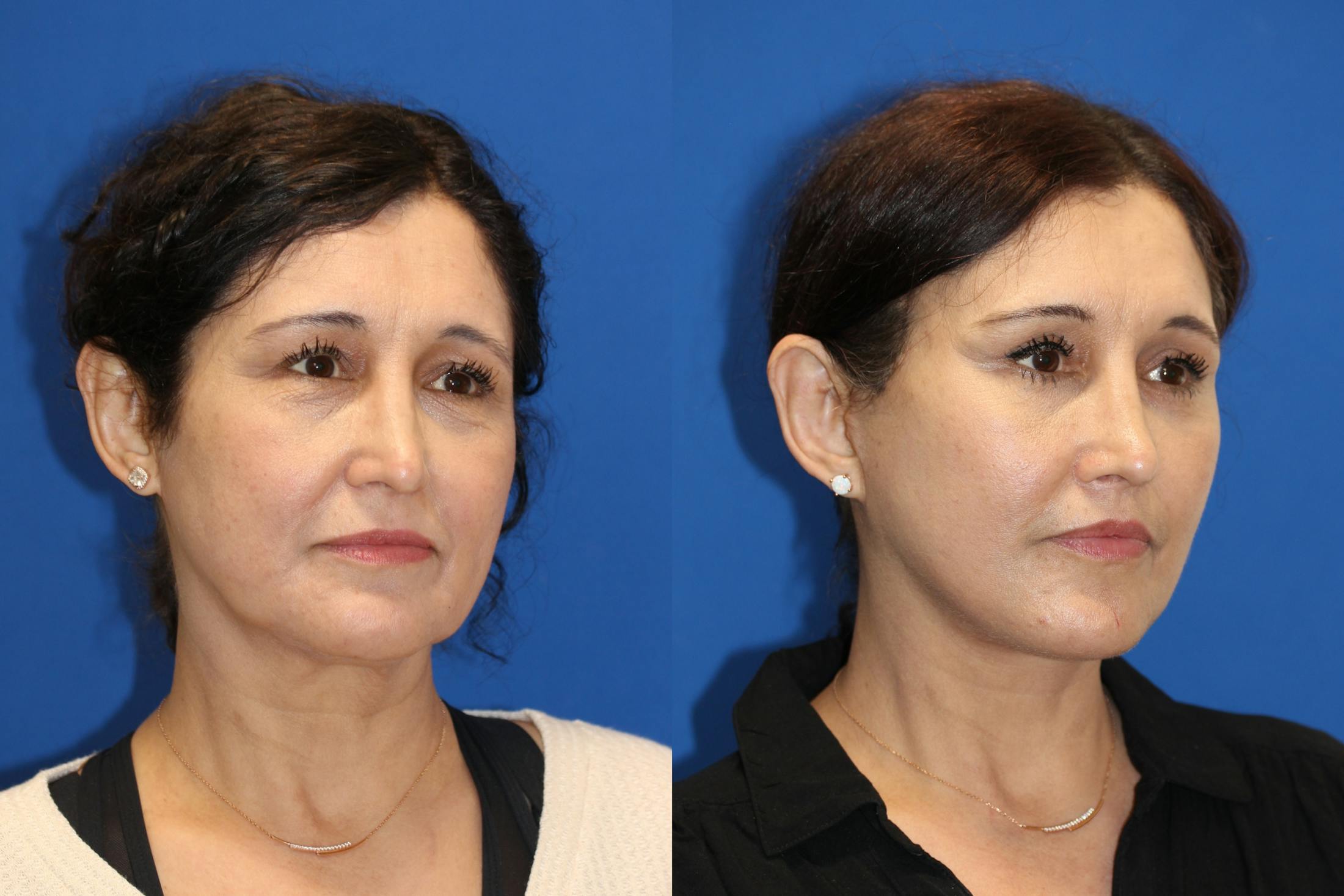 Vertical Restore® / Facial Rejuvenation Before & After Gallery - Patient 123065497 - Image 5
