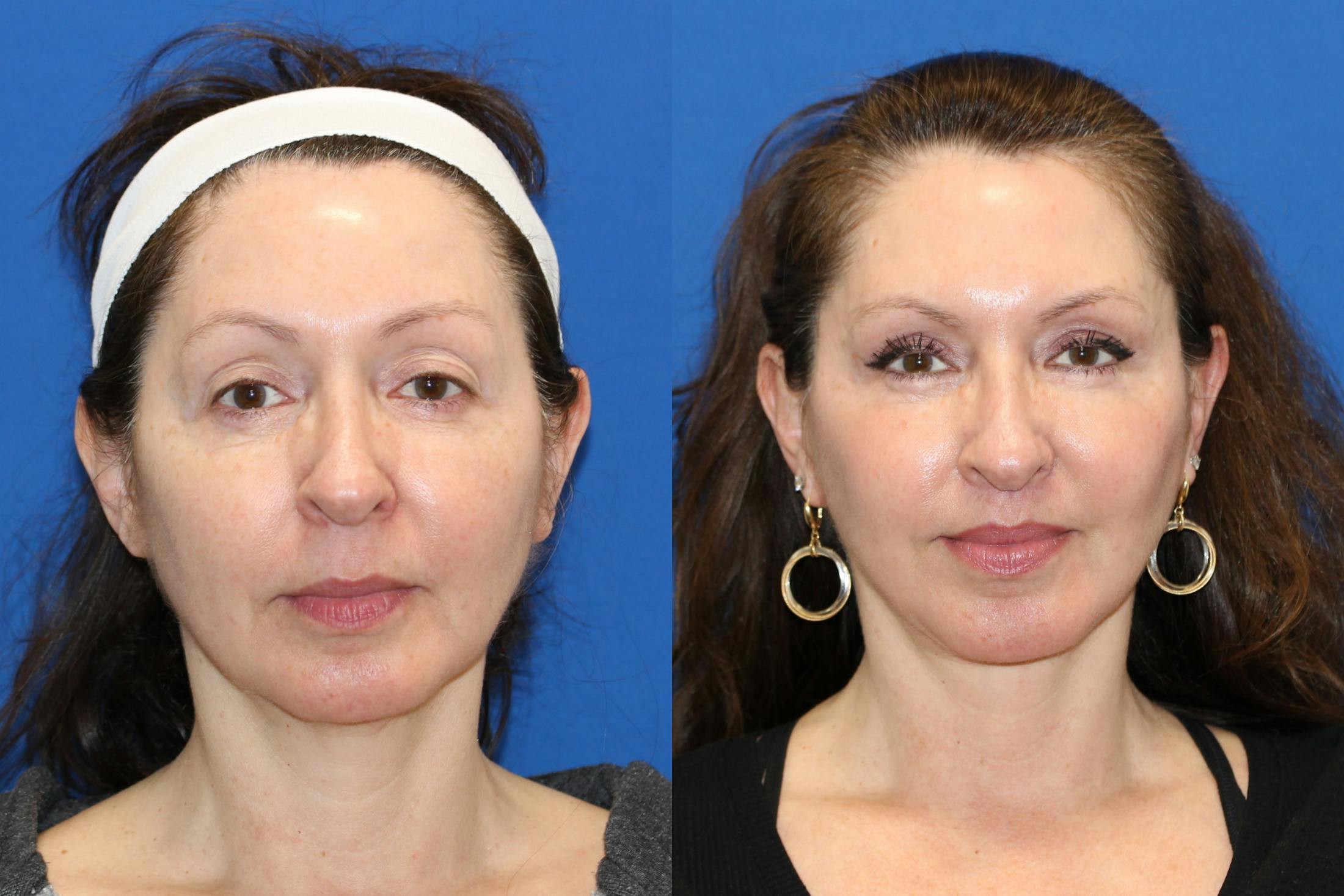 Vertical Restore® / Facial Rejuvenation Before & After Gallery - Patient 123065516 - Image 1
