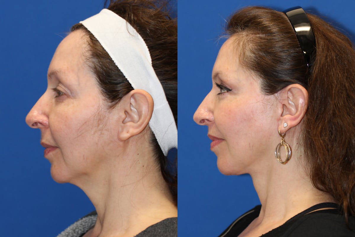 Vertical Restore® / Facial Rejuvenation Before & After Gallery - Patient 123065516 - Image 2