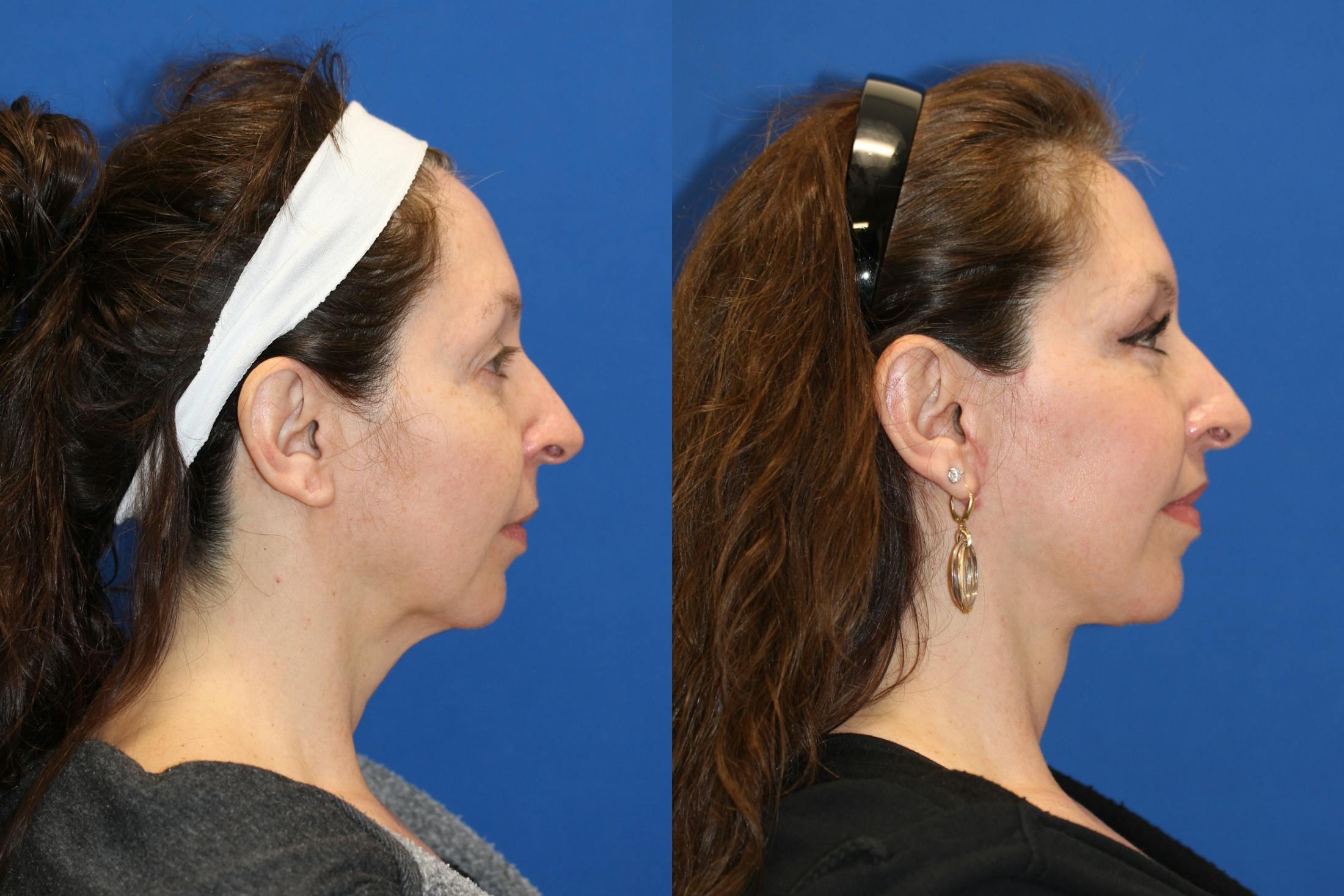 Vertical Restore® / Facial Rejuvenation Before & After Gallery - Patient 123065516 - Image 3