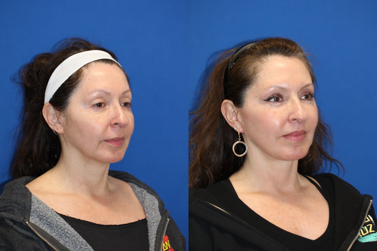 Vertical Restore® / Facial Rejuvenation Before & After Gallery - Patient 123065516 - Image 4