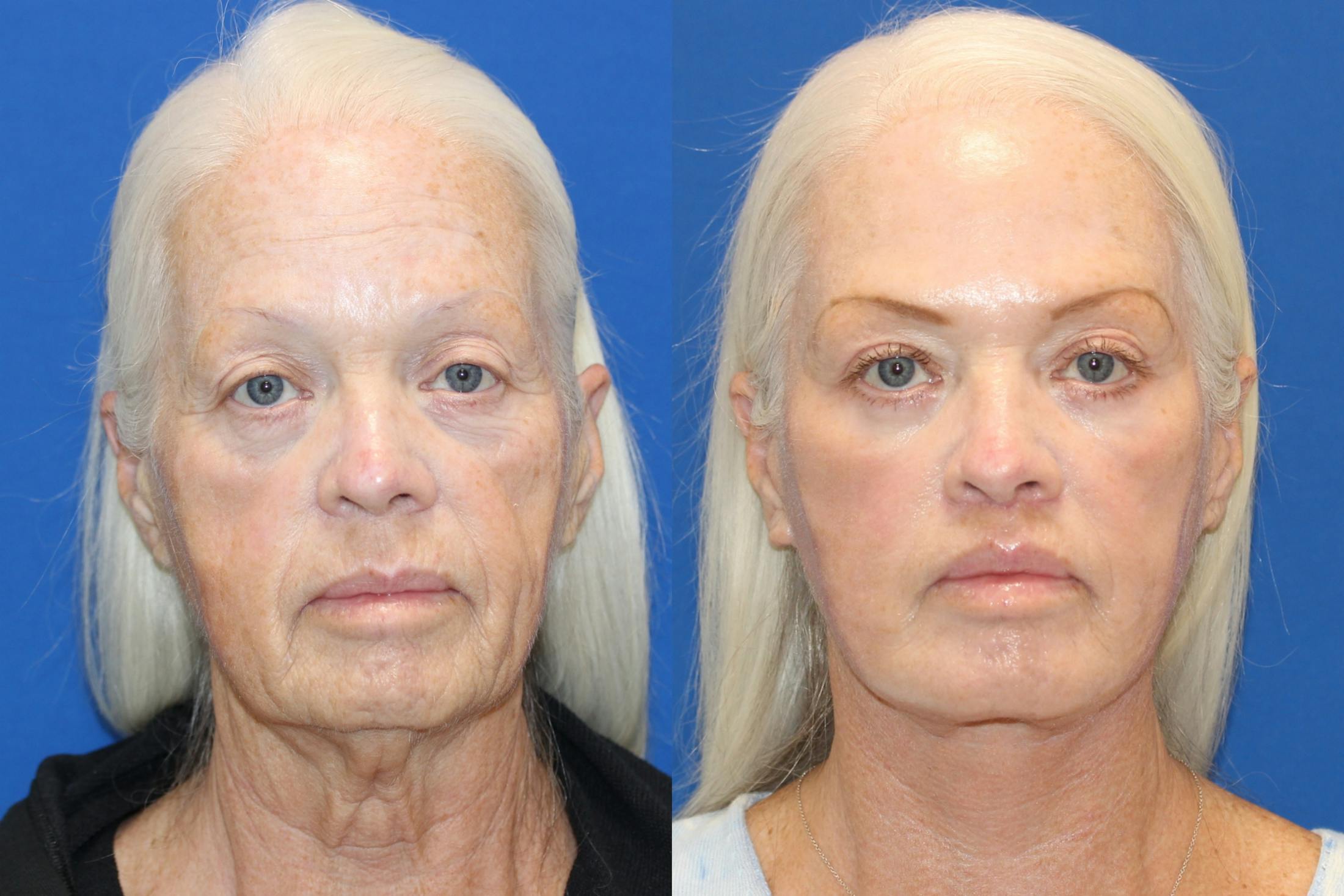 Vertical Restore® / Facial Rejuvenation Before & After Gallery - Patient 123065539 - Image 1