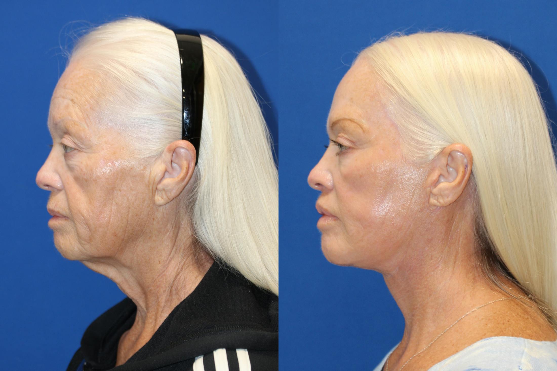 Vertical Restore® / Facial Rejuvenation Before & After Gallery - Patient 123065539 - Image 2