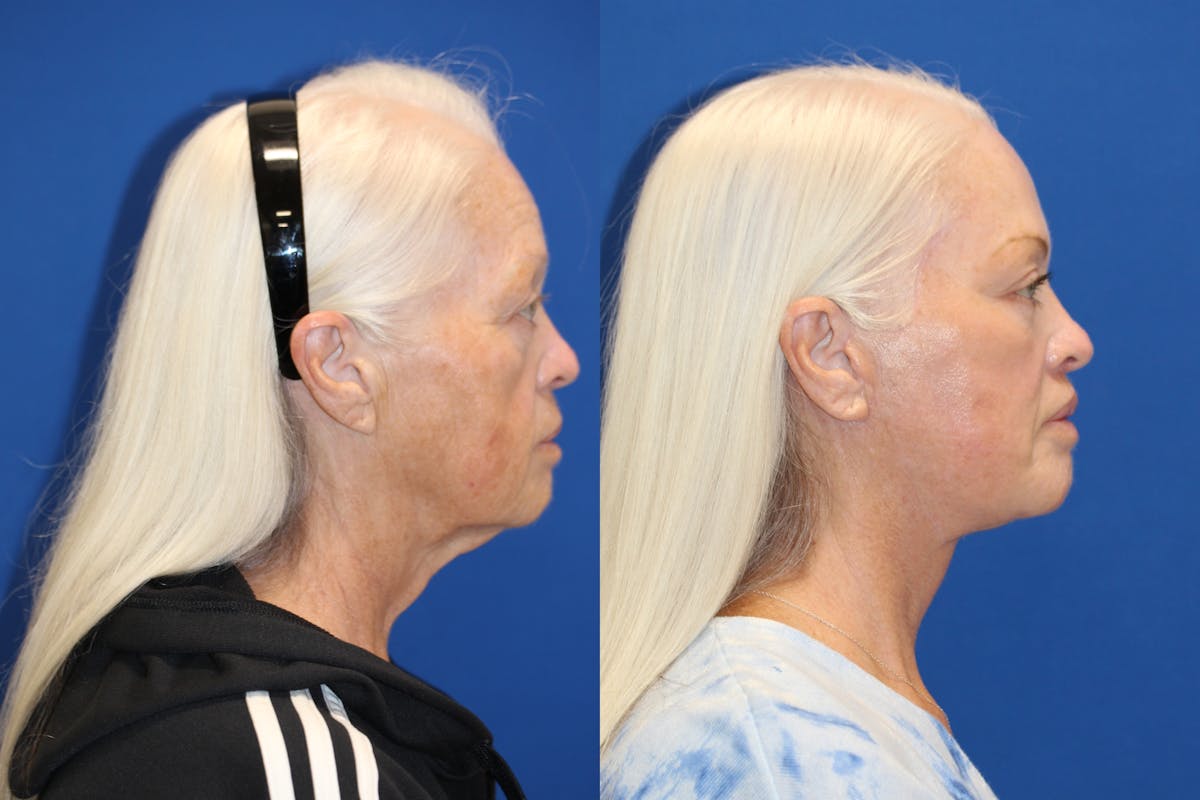 Vertical Restore® / Facial Rejuvenation Before & After Gallery - Patient 123065539 - Image 3