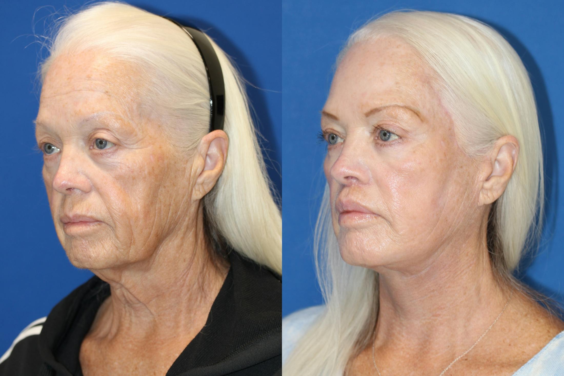 Vertical Restore® / Facial Rejuvenation Before & After Gallery - Patient 123065539 - Image 4