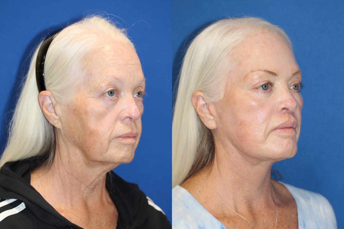 Vertical Restore® / Facial Rejuvenation Before & After Gallery - Patient 123065539 - Image 5