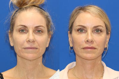 Vertical Restore® / Facial Rejuvenation Before & After Gallery - Patient 148561531 - Image 1
